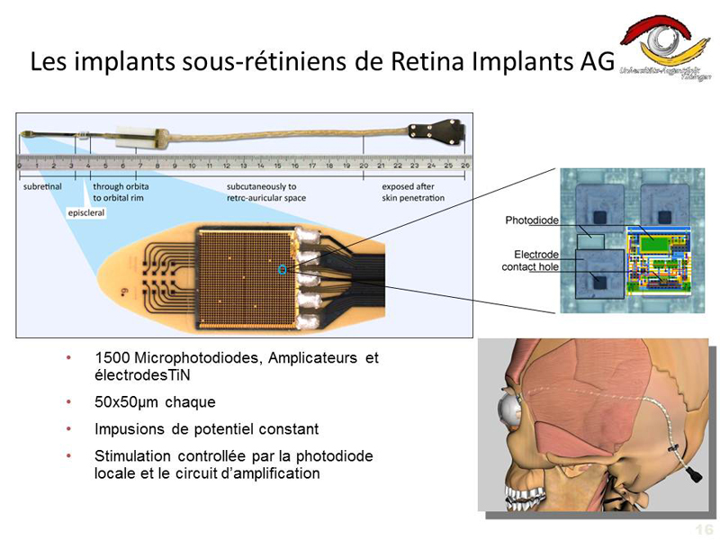 Retina implants AG 01
