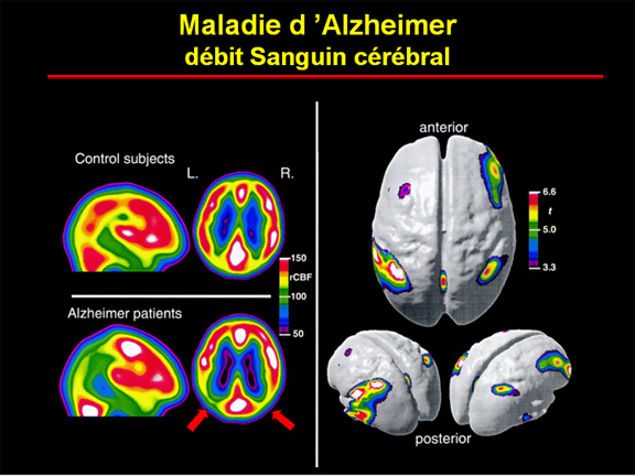 Maladie d'Alzheimer débit sanguin cérébral