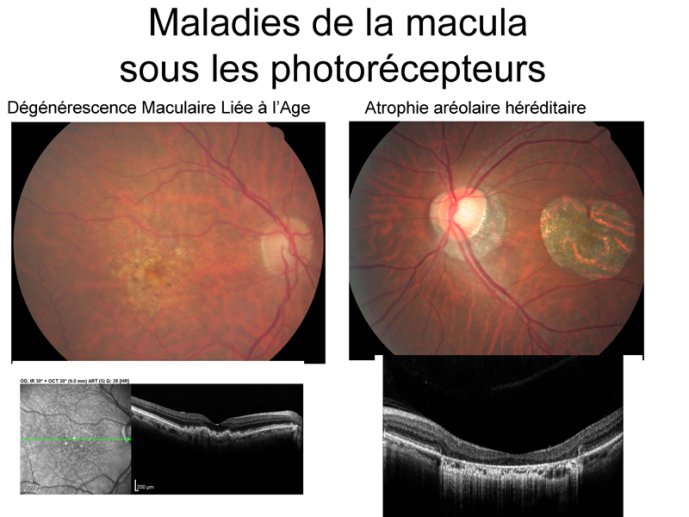 Maladies de la Macula