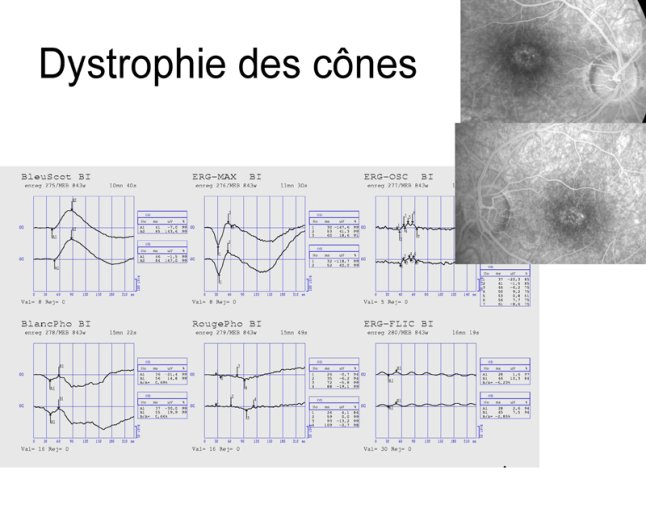 Dystrophie des cônes