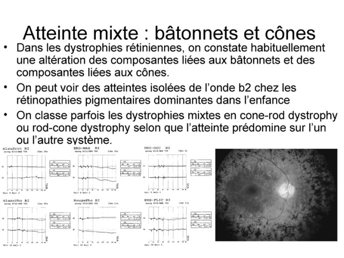 Attente mixte