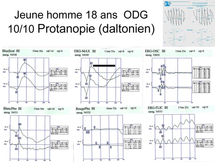 Protanopie