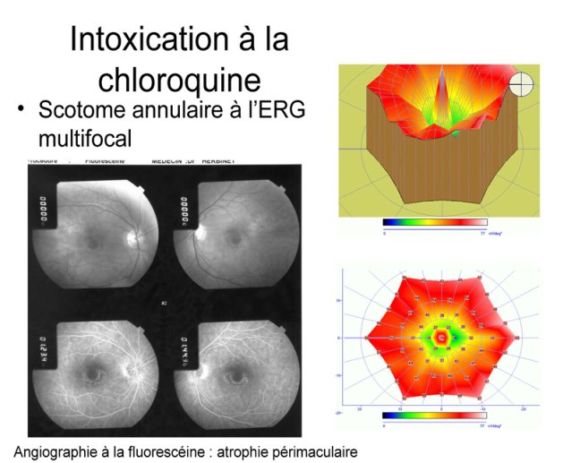 Intoxication à la chloroquine