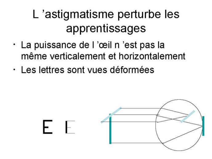 Astigmatisme 01