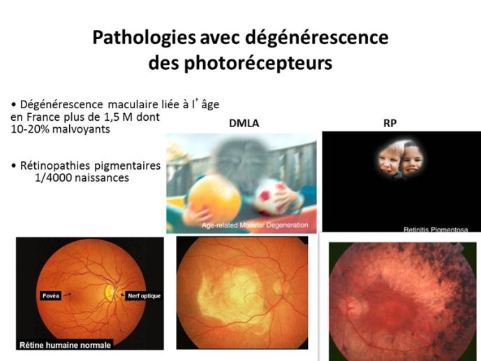 Pathologies des photorécepteurs