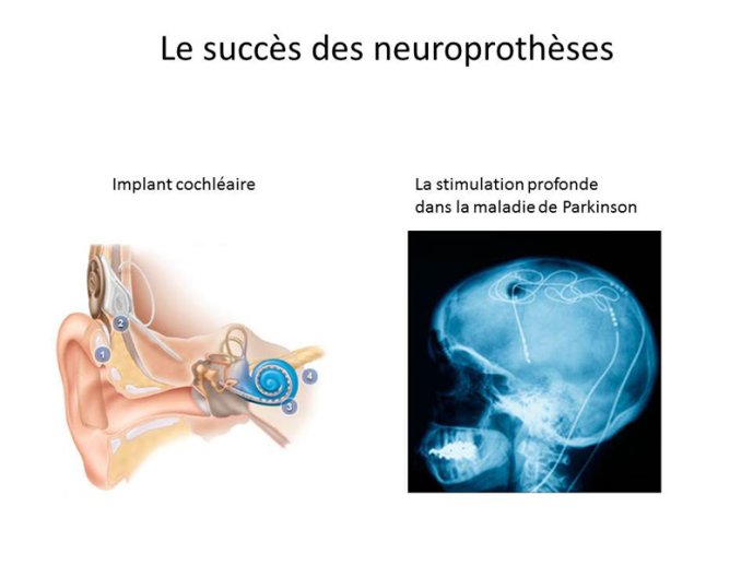 Neuroprothèses