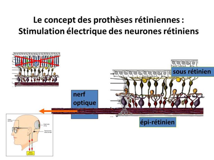 Concept de prothèse rétiniennes