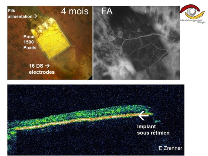 Retina implants AG 02