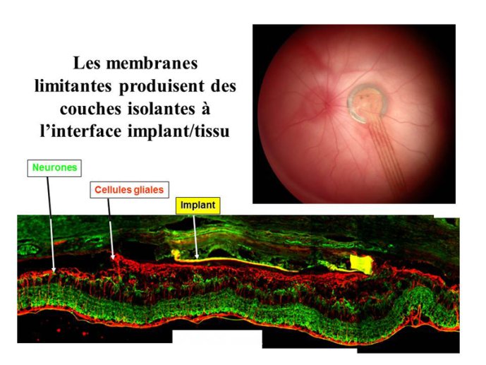 Implant/Tissu