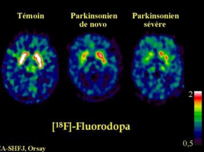 Image 3: dégénérescence du système dopaminergique dans la maladie de Parkinson.