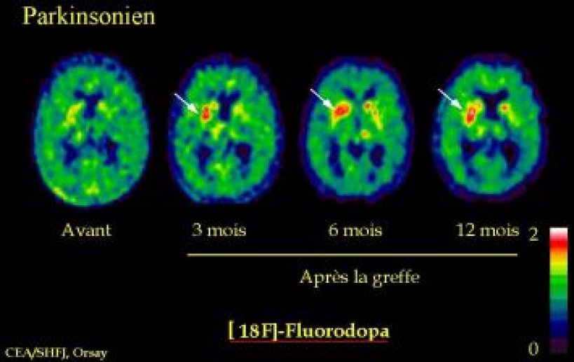 Image 4: suivi de l'effet des greffes neuronales in vivo par TEP.