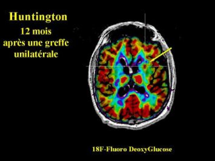 Image 5: greffe neuronale dans la maladie de Huntington.
