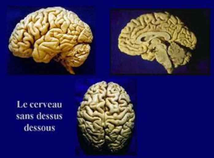 Différentes vues du cerveau