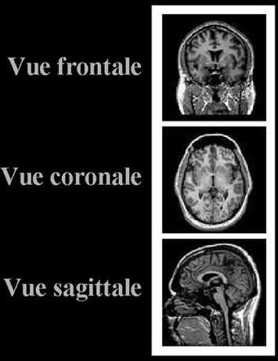 Différentes vues en IRM