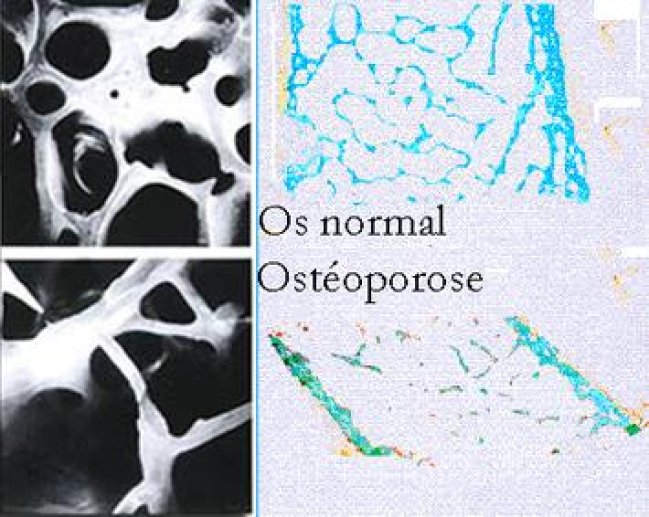 Fig 11 L'os ostéoporotique