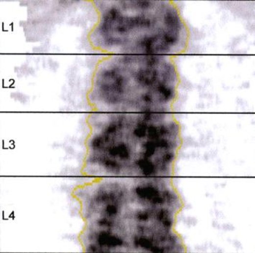 Fig 13 Mesure de la DMO au rachis lombaire