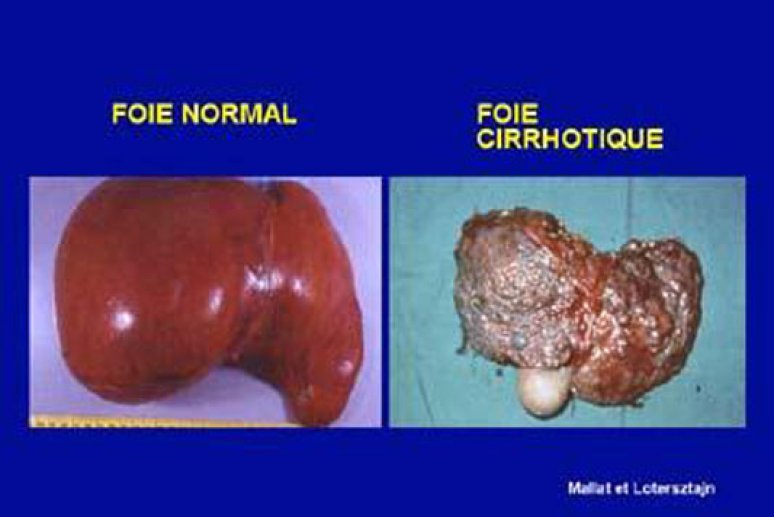 Fig 1 Foie normal foie cirrhotique