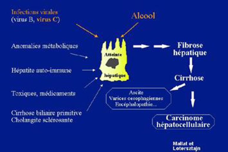 Fig 2  L'atteinte hépatique