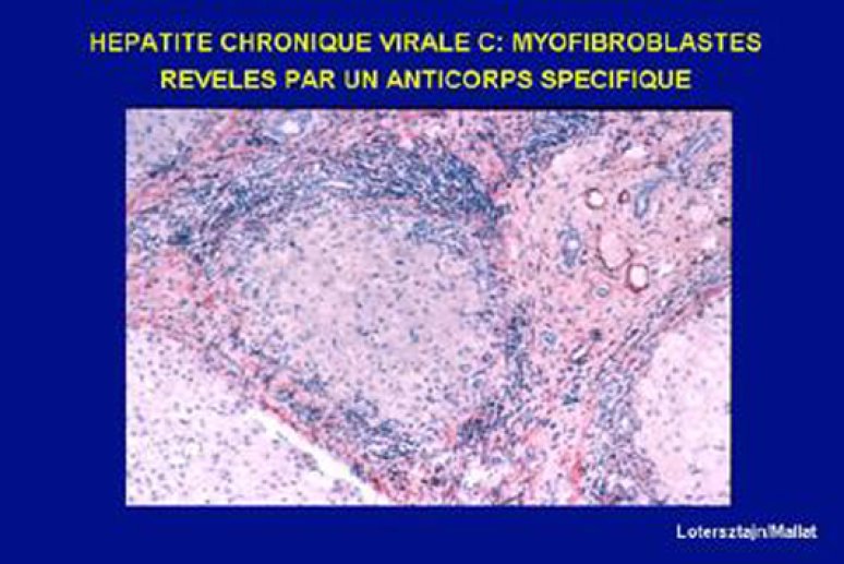 Fig 6 Les myofibroblastes en immunohistochimie