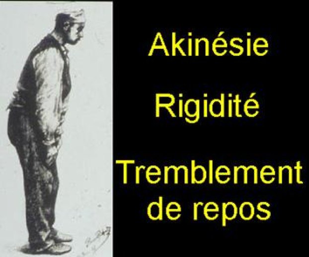 Fig1 Caractéristiques cliniques de la maladie de Parkinson.
