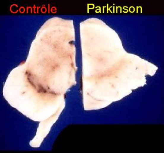 Fig 5 LE PARKINSON
