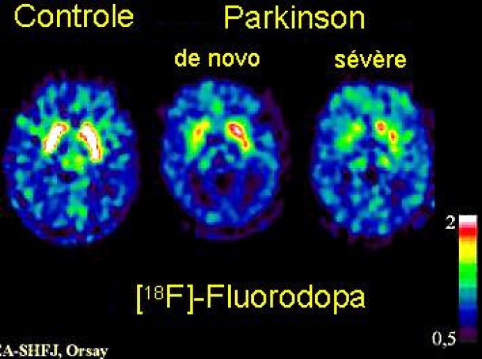 Fig 6 Dégénérescence du système dopaminergique dans la maladie de Parkinson.