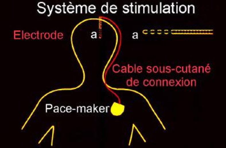 Fig 10 Principe de la stimulation électrique pour soigner les malades atteints de maladie de Parkinson.
