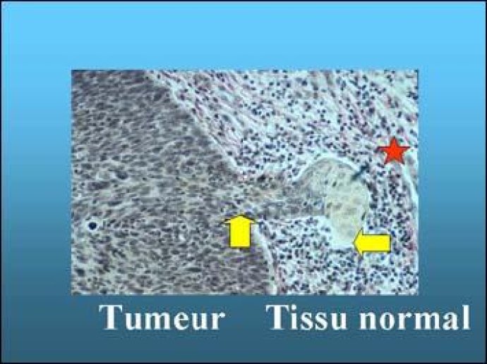 La rupture de la membrane basale
