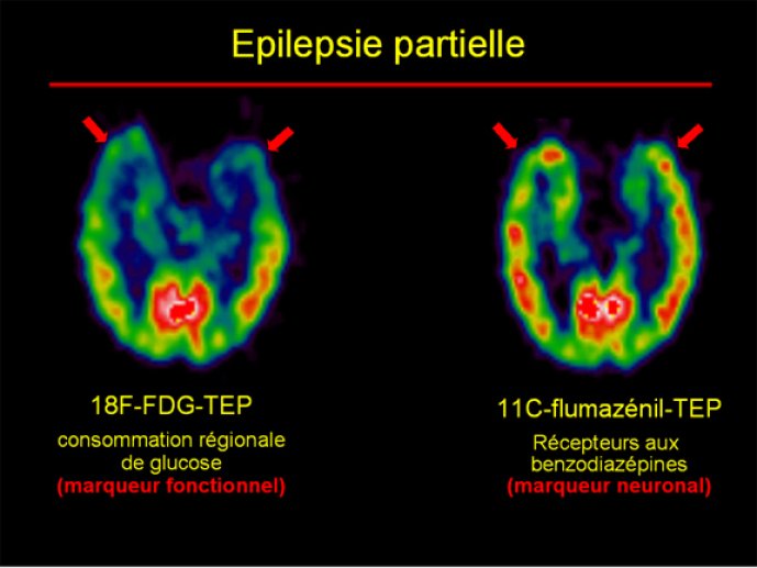 Epilepsie partielle