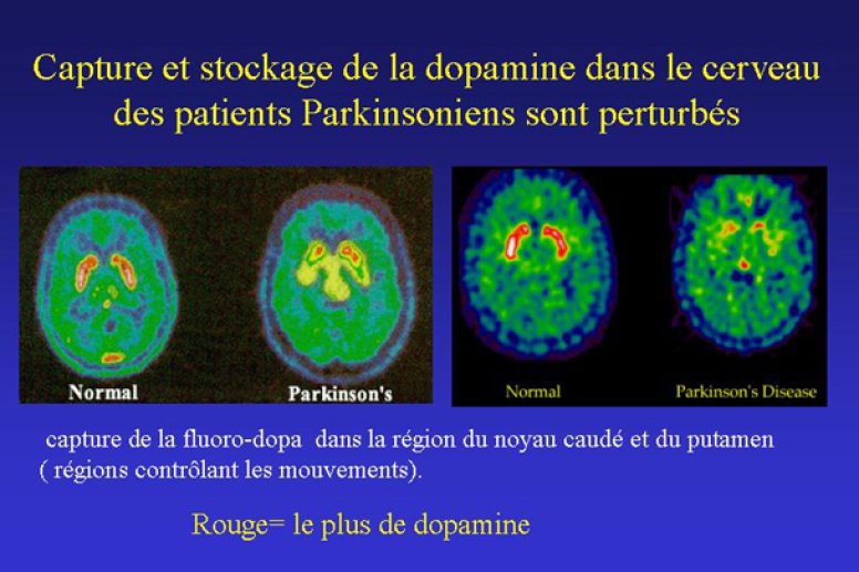 Comparaison entre un cerveau normal etun parkinsonien