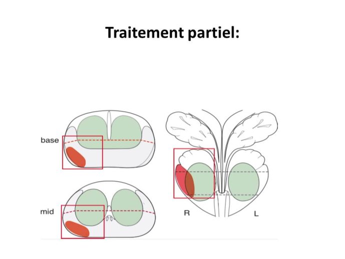 Traitement partiel