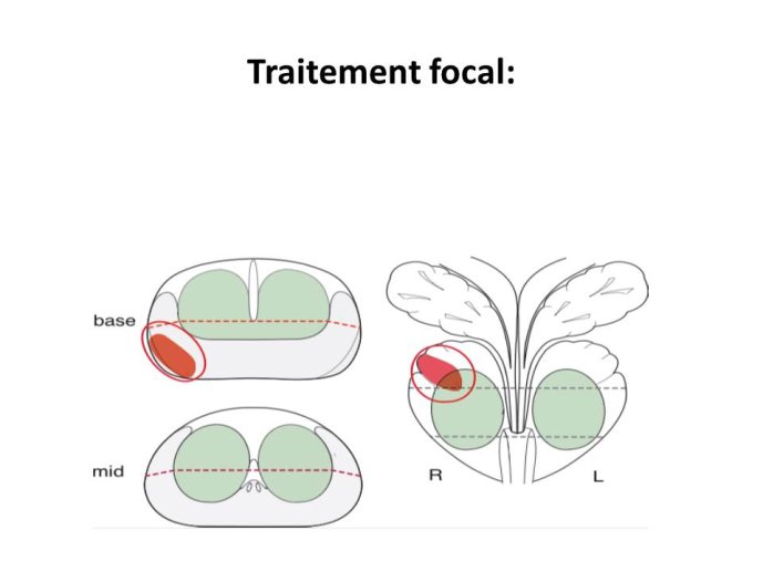 Traitement focal