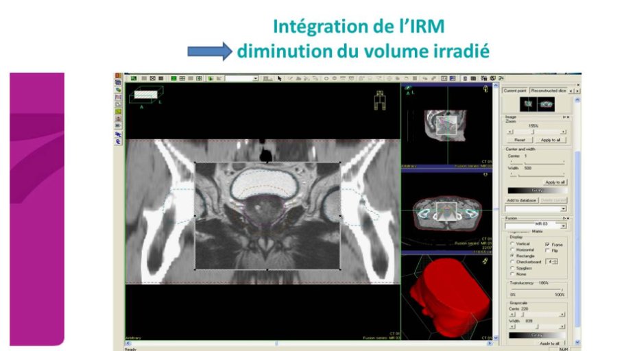 Intégration de l'IRM